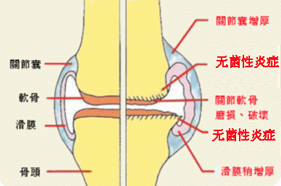 RA热点丨如何做到“关节无炎”？消除关节僵硬、疼痛的症状?！