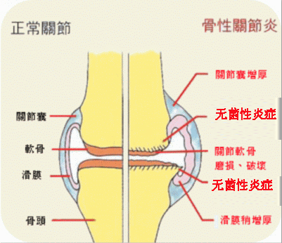 无菌性炎症.jpg