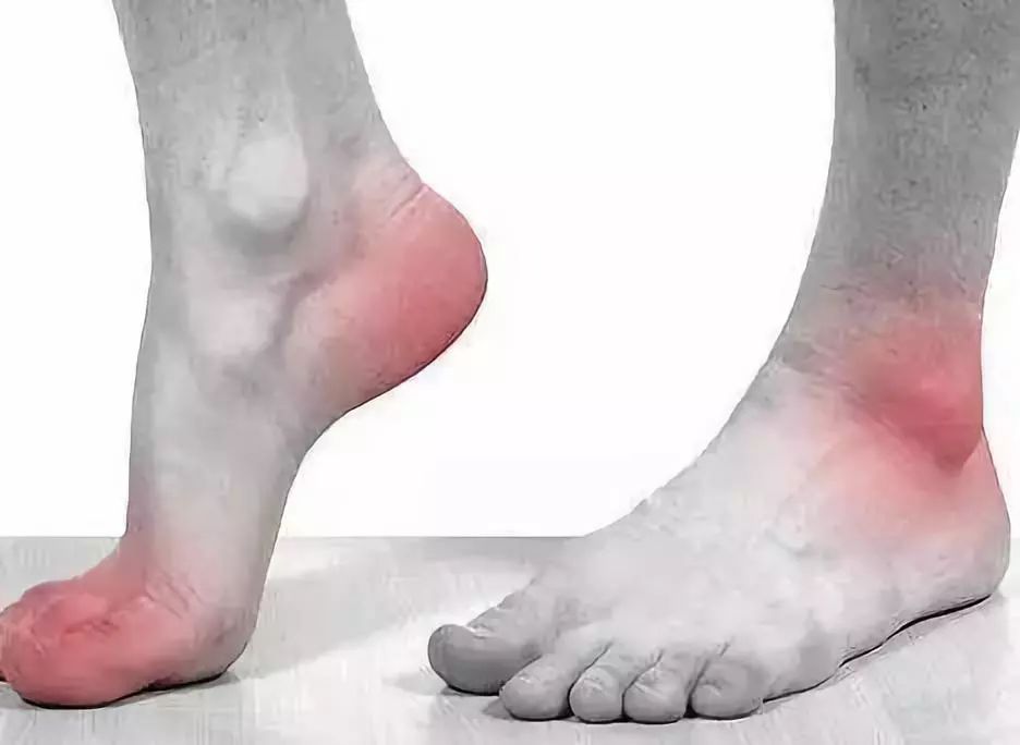 痛风病情加重的征兆
