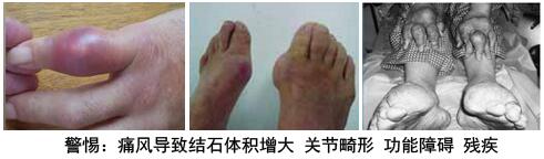 痛风能彻底治好吗?