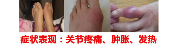 如何治疗痛风病?