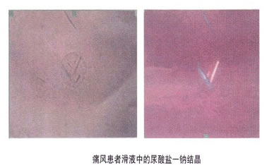 尿酸盐结晶与痛风有什么关联？