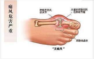 哪些疾病容易被误诊成痛风?