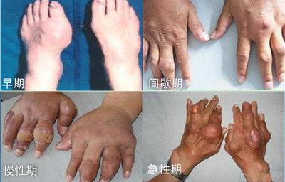 痛风疼痛怎么缓解