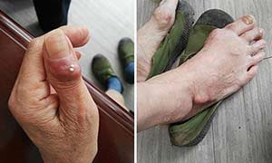 假性痛风是怎么回事？