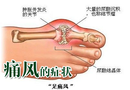 脚痛风怎么治？