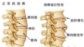 了解病因是治疗颈椎病的前提