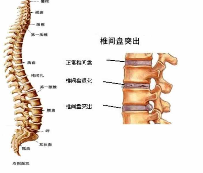 腰椎间盘突出治疗费用是多少呢？