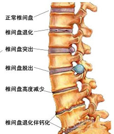 医生解析腰椎间盘突出致病因素