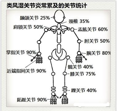 类风湿关节炎应知：4大原则，10条建议