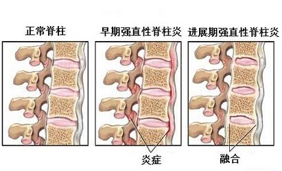 强直性脊柱炎能治好吗?怎么治疗好?