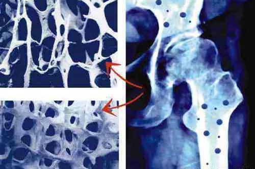 引起骨质疏松的原因有哪些？