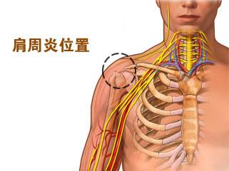 不同时期肩周炎的症状